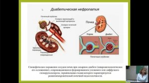 Гирудотерапия в лечении сахарного диабета и его осложнений. Фрагмент вебинара