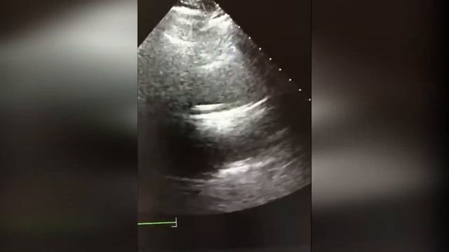 56. Папиллома АК но может и тромб в АО с концом динамика если будет лизис смотреть онлайн