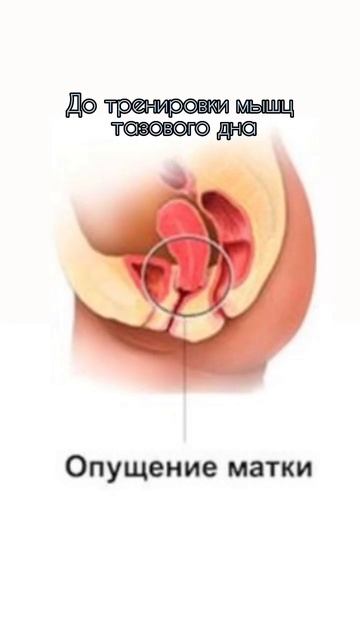 Callibri BeFit поможет устранить проблему с опущением матки смотреть онлайн