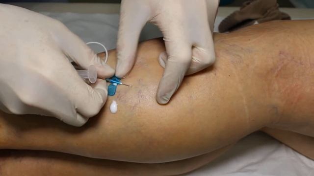 sclerotherapy склеротерапия смотреть онлайн