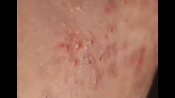 FINDING BLACKHEADS AND EXTRACTING. Выдавливание черных точек
