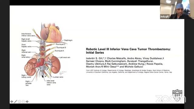 Robotic radical nephrectomy with caval thrombus смотреть онлайн