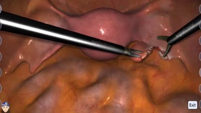 LapSim Gynecology: Ectopic Pregnancy смотреть онлайн