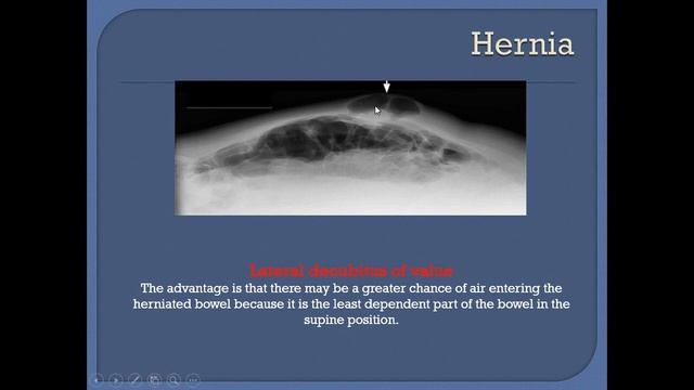 Abdominal X Ray Interpretation | How to read abdomen xray ? смотреть онлайн