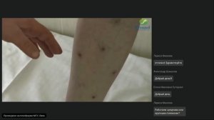 Гирудотерапия против варикоза. Фрагмент вебинара