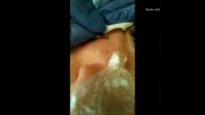 Удаление жировиков