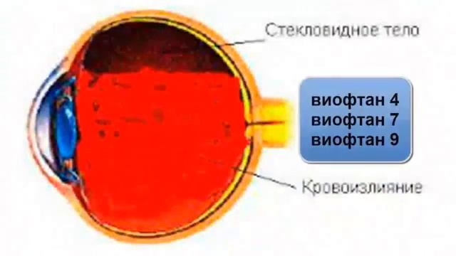 Применение виофтанов при кровоизлиянии в стекловидное тело глаза смотреть онлайн