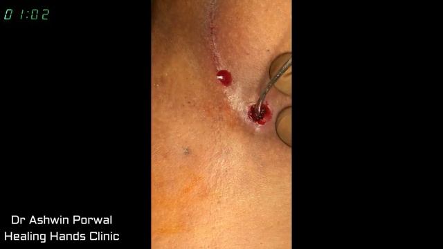 Complex Pilonidal Sinus treated within 3 min with Laser Pilonidotomy by Dr. Ashwin Porwal смотреть онлайн