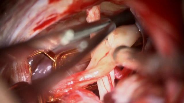 Binder Ring Bypass: V4-V4 Transection, Rerouting and Reanastomosis for Compressive Dolichoectatic V смотреть онлайн