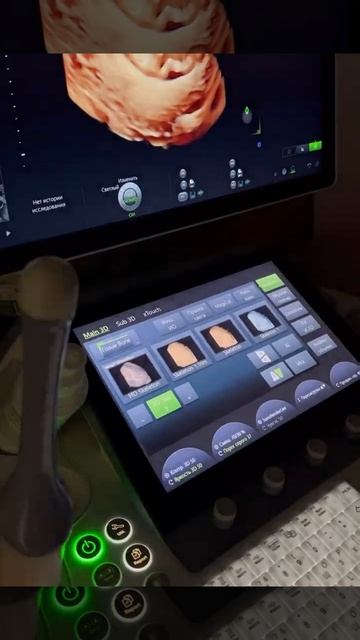 УЗИ на Voluson E10 смотреть онлайн
