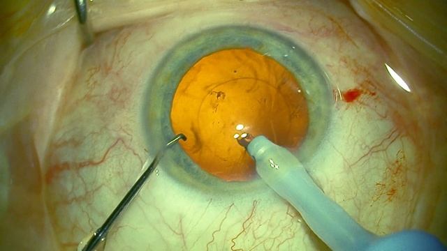 Cataract surgery with the new LuxSmart™ EDOF lens implantation смотреть онлайн