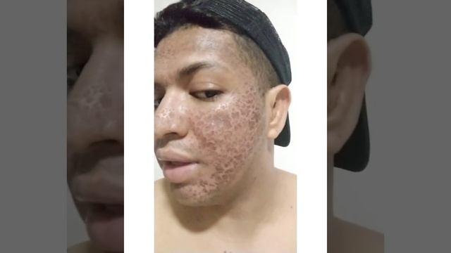 láser CO2 fracionado resultados increíbles смотреть онлайн