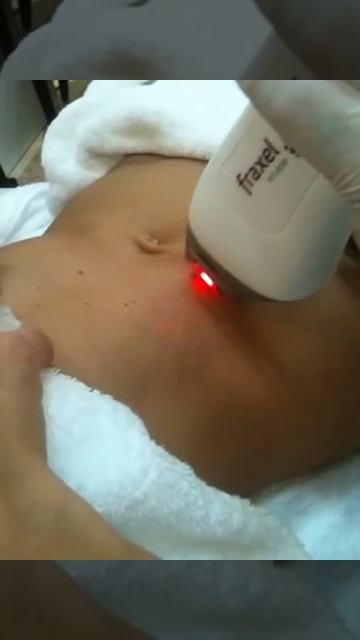 Amazing new stretch marks treatment with fraxel laser MD Cosmedical Solutions смотреть онлайн