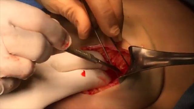 Skin Nipple SFS Sparing Mastectomy- Dr. Robert Rehnke смотреть онлайн