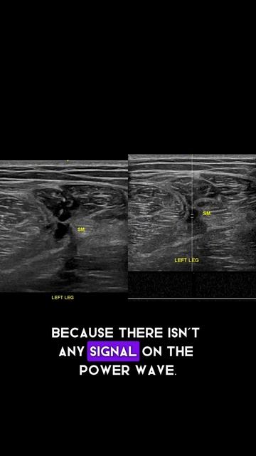 #ultrasound Guided Interventions: Cases (Hamstring Tear Pre-PRP) смотреть онлайн