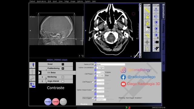 Angiotomografia Cerebral - Siemens Somatom Emotion смотреть онлайн