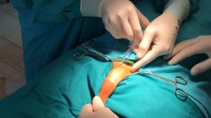 Циркумцизио. Проводниковая анестезия. Обрезание без швов. Alisklamp the best Circumcision device.