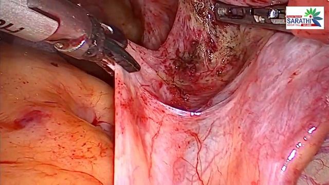 FERTILITY PRESERVING ENDOMETRIOSIS LIVE SURGERY смотреть онлайн