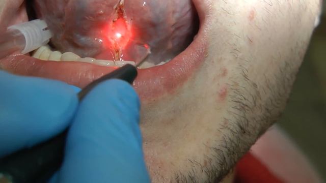 frenulectomia laser смотреть онлайн