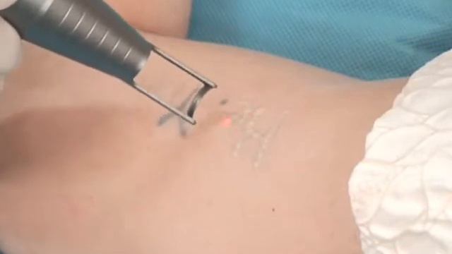 Spectra VRM Laser Tattoo Removal Demo Video of Las Vegas смотреть онлайн