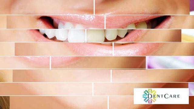 Laser Teeth Whitening in Dubai смотреть онлайн