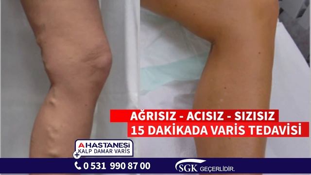 Lazer ile Varis Tedavisi смотреть онлайн