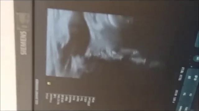 endovenöz lazer ile varis tedavisi смотреть онлайн