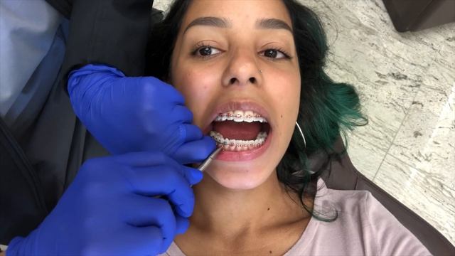 Month 5 braces update/Before & After pictures| Slayitvida смотреть онлайн