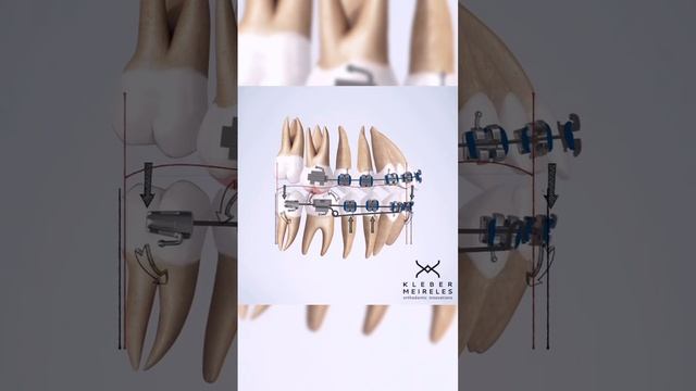 Клинический случай от профессора Kleber Meireles: выраженная кривая Шпее + глубокий прикус смотреть онлайн