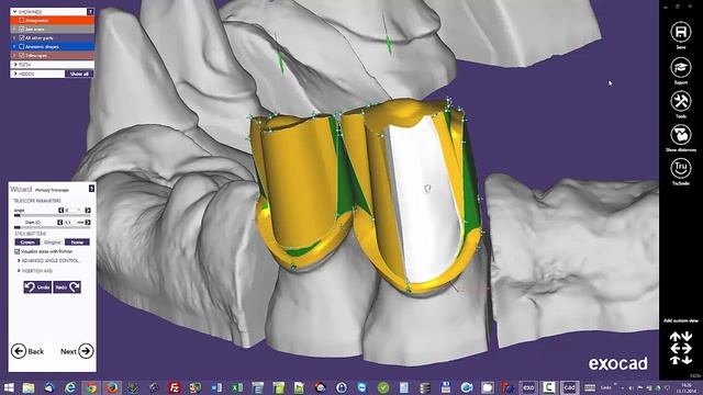 Exocad attachment design demo video-Shining 3D смотреть онлайн