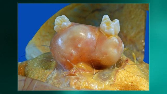 Teratoma смотреть онлайн