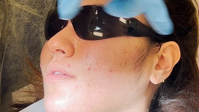 Gow Gates Nerve Block Injection смотреть онлайн