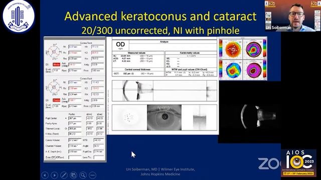 A case based approach to management of post keratoplasty astigmatism - Dr Uri Soiberman смотреть онлайн
