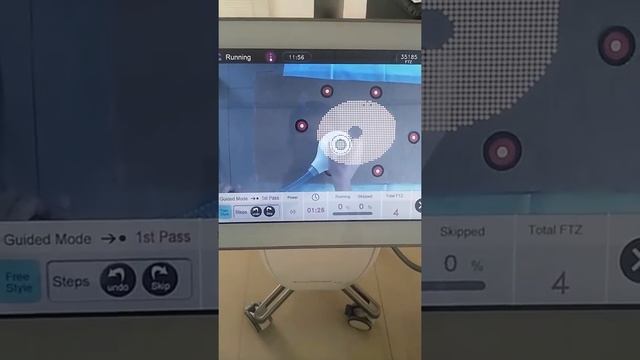 Focushape Triangelaser смотреть онлайн