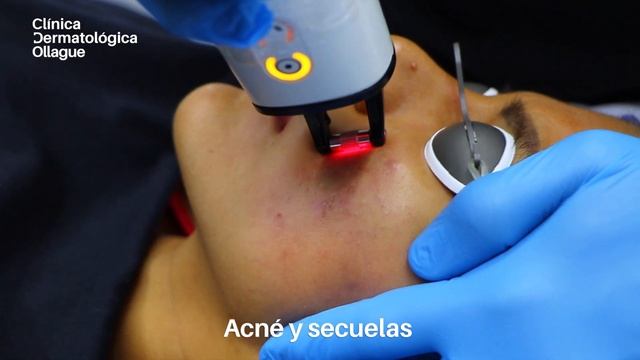 Presentación de nueva tecnología: Nordlys | Clínica Dermatológica Ollague смотреть онлайн