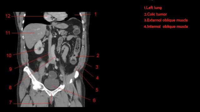 How to read ct abdomen Coronal image смотреть онлайн