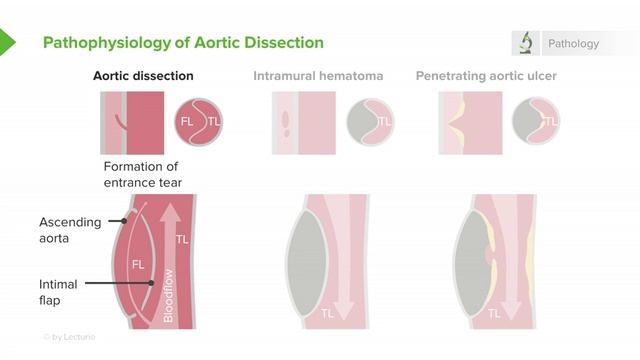 1.04 Aortic Dissection- Incidence & Risk Factors смотреть онлайн