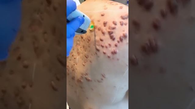 Vbeam Prima Pulsed Dye Laser | Keloid Hypertrophic Scars | West Hollywood, CA | Dr. Jason Emer смотреть онлайн