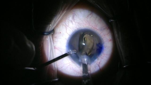 ARTIFICIALIRIS: Management of congenital aniridia with cataract and astigmatism смотреть онлайн