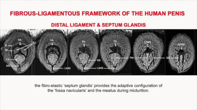 Hypospadias surgery 2022 - www.arthypospadias.com смотреть онлайн