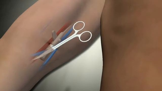 Invisiport Removal Procedure - Medical Animation смотреть онлайн