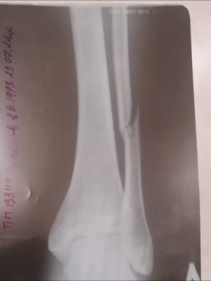 ПЕРЕЛОМ  малой берцовой кости со смещением. Прошло 2 месяца