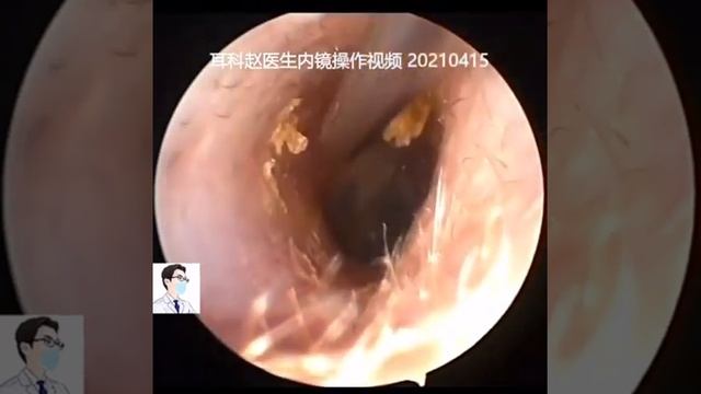Best Ear Wax Removal & Extraction with Vacuum Remover 真空リムーバーによるにきびの除去と抽出 10 смотреть онлайн