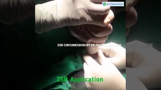 ZSR CIRCUMCISION BY Dr Palash Mallick Sir Senior Laser & Laparoscopic Surgeon