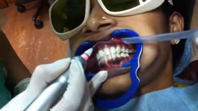 Gingival Depigmentation with diode laser смотреть онлайн