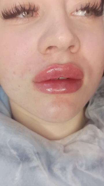 Увеличение губ филлером. Сочные губы! смотреть онлайн