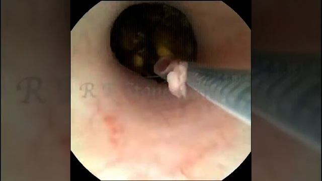 Kidney Stone Removal with RIRS Technology смотреть онлайн