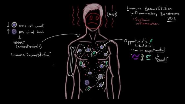 Immune reconstitution inflammatory syndrome (IRIS) in AIDS | NCLEX-RN | Khan Academy смотреть онлайн