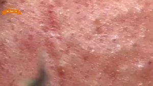 Удаление прыщей с носа и щек Spa G  #047