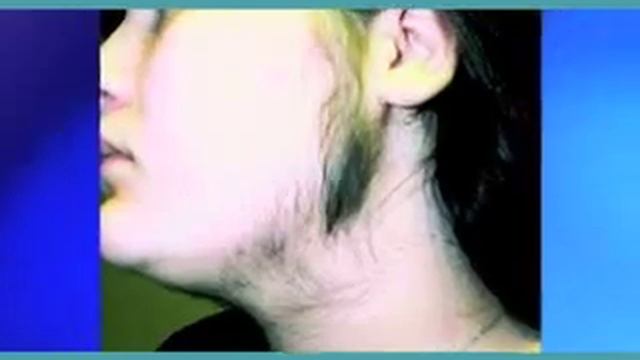 Emilia Schinner empfiehlt Haarentfernung mit Candela-Laser смотреть онлайн